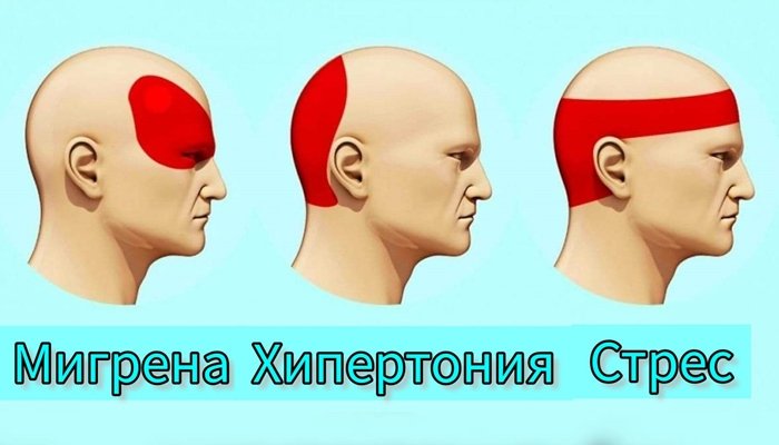 мигрена хипертония стрес