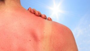 blog sunburn