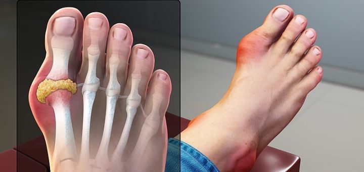 New Balance Arthritic Shoes