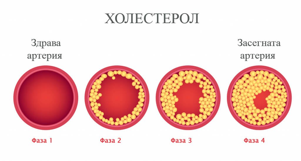 holeterol aterii